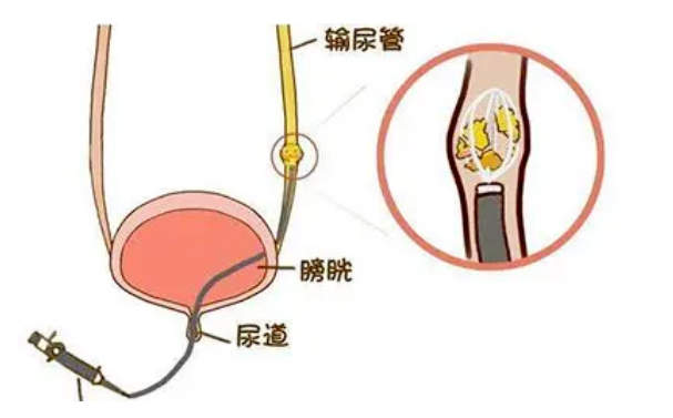 『科普』令人“痛不欲生”的输尿管结石
