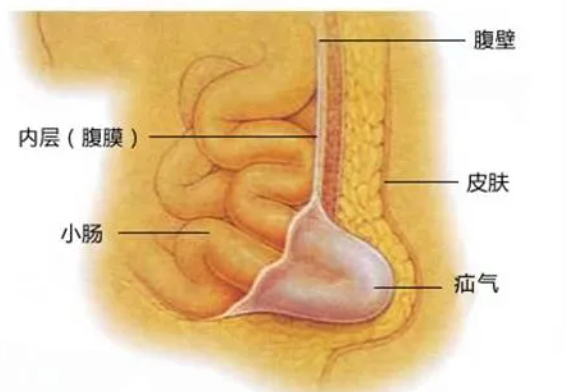 『科普』来者不善的“疝气”，勿以“疝”小而不为！