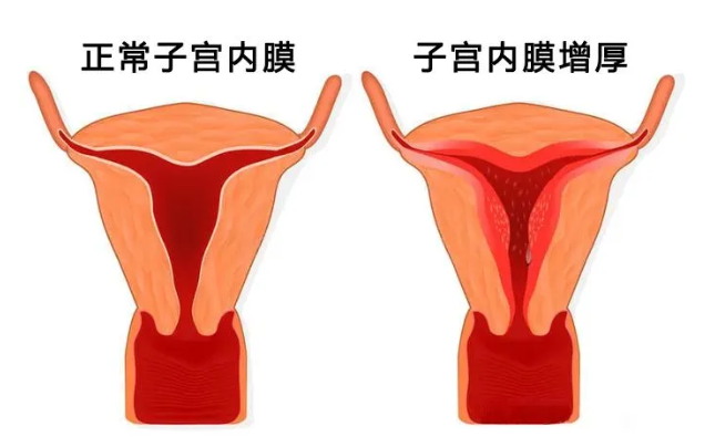 『“更年期”科普』如何发现围绝经期和绝经后期子宫内膜的异常？